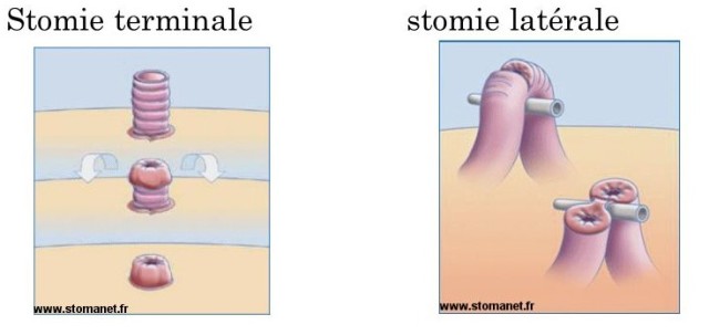 stomie-digestive